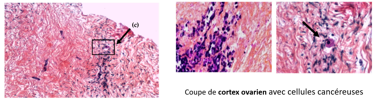 Coupe du tissus périphérique de l'ovaire (cortex ovarien) montrant des cellules cancéreuses